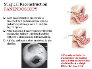 Surgical Reconstruction
PANENDOSCOPY
 Each reconstructive procedure is
preceded by a panendoscopy using a
pediatric cystoscope with 0- and 30-
degree optics.
 After passing a Fogarty catheter into the
vagina, the balloon is inflated and the
catheter is clamped and left indwelling.
 A Foley catheter is then anchored in the
bladder.
A Fogarty catheter is
placed into the vagina
and a Foley catheter into
the bladder ( a ) high
UGS, ( b ) low UGS
 