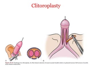 Clitoroplasty
 