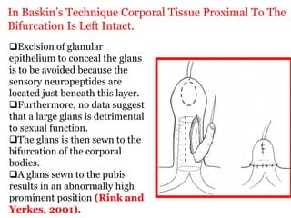 In Baskin’s Technique Corporal Tissue Proximal To The
Bifurcation Is Left Intact.
Excision of glanular
epithelium to conceal the glans
is to be avoided because the
sensory neuropeptides are
located just beneath this layer.
Furthermore, no data suggest
that a large glans is detrimental
to sexual function.
The glans is then sewn to the
bifurcation of the corporal
bodies.
A glans sewn to the pubis
results in an abnormally high
prominent position (Rink and
Yerkes, 2001).
 