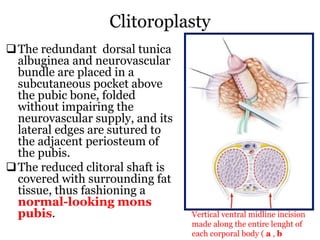 Clitoroplasty
The redundant dorsal tunica
albuginea and neurovascular
bundle are placed in a
subcutaneous pocket above
the pubic bone, folded
without impairing the
neurovascular supply, and its
lateral edges are sutured to
the adjacent periosteum of
the pubis.
The reduced clitoral shaft is
covered with surrounding fat
tissue, thus fashioning a
normal-looking mons
pubis. Vertical ventral midline incision
made along the entire lenght of
each corporal body ( a , b
 