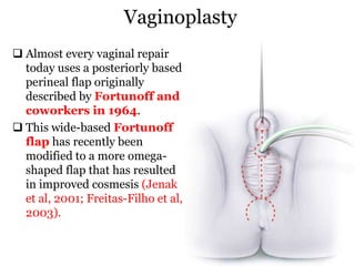 Vaginoplasty
 Almost every vaginal repair
today uses a posteriorly based
perineal flap originally
described by Fortunoff and
coworkers in 1964.
 This wide-based Fortunoff
flap has recently been
modified to a more omega-
shaped flap that has resulted
in improved cosmesis (Jenak
et al, 2001; Freitas-Filho et al,
2003).
 