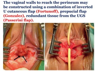 The vaginal walls to reach the perineum may
be constructed using a combination of inverted
U cutaneous flap (Fortunoff), prepucial flap
(Gonzalez), redundant tissue from the UGS
(Passerini flap).
 
