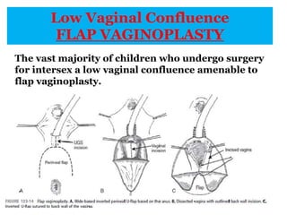 Low Vaginal Confluence
FLAP VAGINOPLASTY
The vast majority of children who undergo surgery
for intersex a low vaginal confluence amenable to
flap vaginoplasty.
 