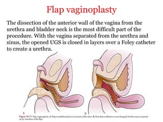 Flap vaginoplasty
The dissection of the anterior wall of the vagina from the
urethra and bladder neck is the most difficult part of the
procedure. With the vagina separated from the urethra and
sinus, the opened UGS is closed in layers over a Foley catheter
to create a urethra.
 