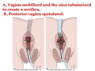 A, Vagina mobilized and the sinu tubularized
to create a urethra.
B, Posterior vagina spatulated.
 