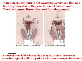 A buttocks- or labial-based flap may be used to create the
anterior vaginal wall in a patient with a pure urogenital sinus
When preputial skin is not available, a buttock flap or a
laterally based skin flap can be used (Parrott and
Woodard, 1991; Dumanian and Donahoe, 1992)
 