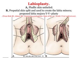 Labioplasty.
A, Phallic skin unfurled.
B, Preputial skin split and used to create the labia minora;
proposed labia majora Y-V–plasty
. (From Rink RC, Adams MC: Feminizing genitoplasty: State of the art. World J Urol 1998;16:212).
 