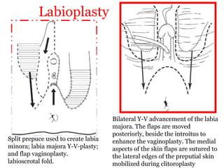 Labioplasty
Split prepuce used to create labia
minora; labia majora Y-V-plasty;
and flap vaginoplasty.
labioscrotal fold.
Bilateral Y-V advancement of the labia
majora. The flaps are moved
posteriorly, beside the introitus to
enhance the vaginoplasty. The medial
aspects of the skin flaps are sutured to
the lateral edges of the preputial skin
mobilized during clitoroplasty
 
