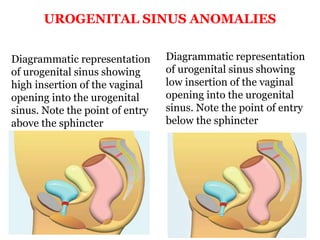 Diagrammatic representation
of urogenital sinus showing
high insertion of the vaginal
opening into the urogenital
sinus. Note the point of entry
above the sphincter
Diagrammatic representation
of urogenital sinus showing
low insertion of the vaginal
opening into the urogenital
sinus. Note the point of entry
below the sphincter
UROGENITAL SINUS ANOMALIES
 