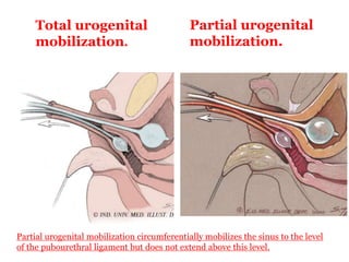 Total urogenital
mobilization.
Partial urogenital
mobilization.
Partial urogenital mobilization circumferentially mobilizes the sinus to the level
of the pubourethral ligament but does not extend above this level.
 