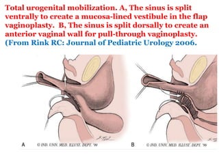 Total urogenital mobilization. A, The sinus is split
ventrally to create a mucosa-lined vestibule in the flap
vaginoplasty. B, The sinus is split dorsally to create an
anterior vaginal wall for pull-through vaginoplasty.
(From Rink RC: Journal of Pediatric Urology 2006.
 