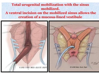Total urogenital mobilization with the sinus
mobilized.
A ventral incision on the mobilized sinus allows the
creation of a mucosa-lined vestibule
 