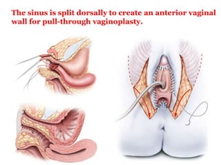 The sinus is split dorsally to create an anterior vaginal
wall for pull-through vaginoplasty.
 
