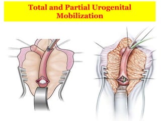 Total and Partial Urogenital
Mobilization
 