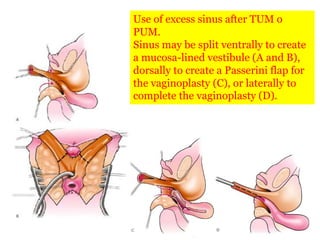 Use of excess sinus after TUM o
PUM.
Sinus may be split ventrally to create
a mucosa-lined vestibule (A and B),
dorsally to create a Passerini flap for
the vaginoplasty (C), or laterally to
complete the vaginoplasty (D).
 