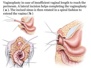 Vaginoplasty in case of insufficient vaginal length to reach the
perineum. A lateral incision helps completing the vaginoplasty
( a ). The incised sinus is then rotated in a spiral fashion to
extend the vagina ( b )
 