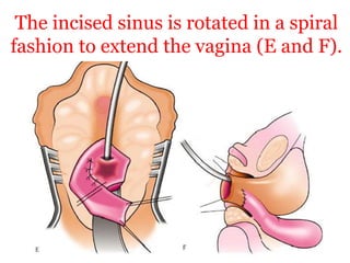 The incised sinus is rotated in a spiral
fashion to extend the vagina (E and F).
 