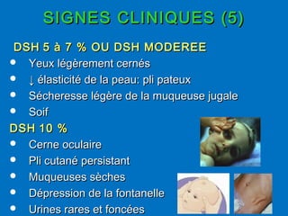 SIGNES CLINIQUES (5)SIGNES CLINIQUES (5)
DSHDSH 5 à 7 % OU DSH MODEREE5 à 7 % OU DSH MODEREE
 Yeux légèrement cernésYeux légèrement cernés
 ↓↓ élasticité de la peau: pli pateuxélasticité de la peau: pli pateux
 Sécheresse légère de la muqueuse jugaleSécheresse légère de la muqueuse jugale
 SoifSoif
DSHDSH 10 %10 %
 Cerne oculaireCerne oculaire
 Pli cutané persistantPli cutané persistant
 Muqueuses sèchesMuqueuses sèches
 Dépression de la fontanelleDépression de la fontanelle
 Urines rares et foncéesUrines rares et foncées
 
