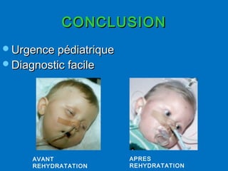 CONCLUSIONCONCLUSION
Urgence pédiatriqueUrgence pédiatrique
Diagnostic facileDiagnostic facile
AVANT
REHYDRATATION
APRES
REHYDRATATION
 