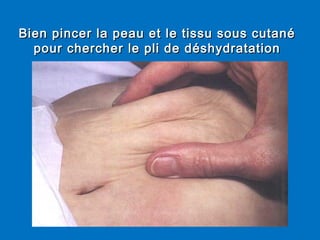 Bien pincer la peau et le tissu sous cutanéBien pincer la peau et le tissu sous cutané
pour chercher le pli de déshydratationpour chercher le pli de déshydratation
 