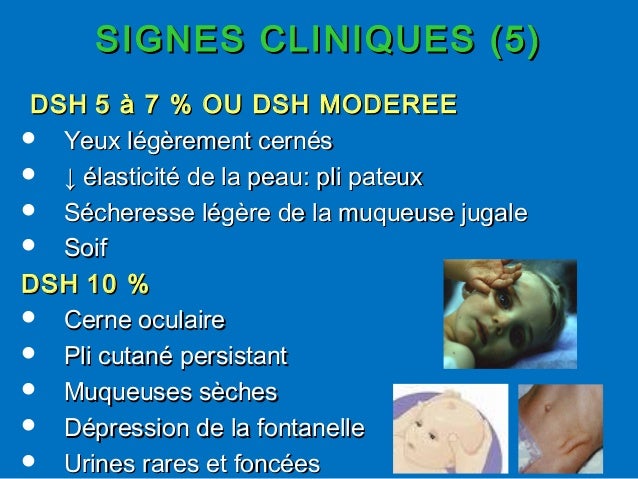 Deshydratation Aigue Du Nourisson