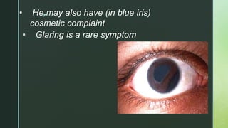 z• He may also have (in blue iris)
cosmetic complaint
• Glaring is a rare symptom
 
