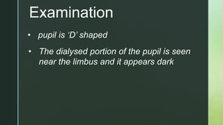 zExamination
• pupil is ‘D’ shaped
• The dialysed portion of the pupil is seen
near the limbus and it appears dark
 