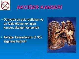 AKCİĞER KANSERİ

 Dünyada en çok rastlanan ve
  en fazla ölüme yol açan
  kanser, akciğer kanseridir

 Akciğer kanserlerinin % 95’i
  sigaraya bağlıdır
 
