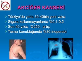 AKCİĞER KANSERİ
 Türkiye’de yılda 30-40bin yeni vaka
 Sigara kullanmayanlarda %0,1-0,2
 Son 40 yılda %250 artış
 Tanısı konulduğunda %80 inoperabl
 