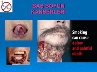BAŞ BOYUN
KANSERLERİ
 