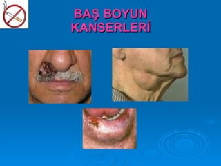 BAŞ BOYUN
KANSERLERİ
 