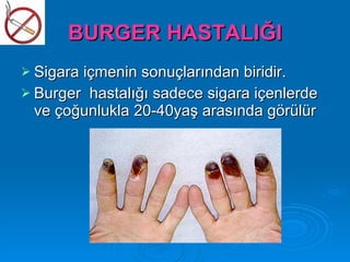 BURGER HASTALIĞI
 Sigara içmenin sonuçlarından biridir.
 Burgerhastalığı sadece sigara içenlerde
 ve çoğunlukla 20-40yaş arasında görülür
 