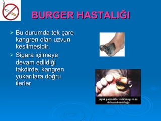 BURGER HASTALIĞI
   Bu durumda tek çare
    kangren olan uzvun
    kesilmesidir.
   Sigara içilmeye
    devam edildiği
    takdirde, kangren
    yukarılara doğru
    ilerler
 
