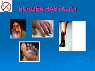 BURGER HASTALIĞI
 