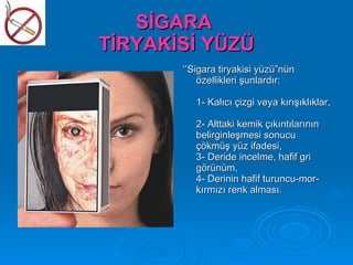 SİGARA
TİRYAKİSİ YÜZÜ
       ‘’Sigara tiryakisi yüzü”nün
           özellikleri şunlardır:

          1- Kalıcı çizgi veya kırışıklıklar,

          2- Alttaki kemik çıkıntılarının
          belirginleşmesi sonucu
          çökmüş yüz ifadesi,
          3- Deride incelme, hafif gri
          görünüm,
          4- Derinin hafif turuncu-mor-
          kırmızı renk alması.
 