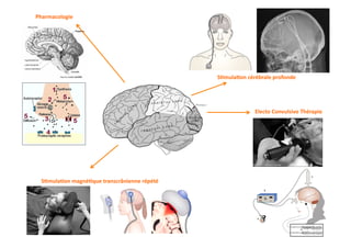 Pharmacologie	
  




                                                           S3mula3on	
  cérébrale	
  profonde	
  




                                                                            Electo	
  Convulsivo	
  Thérapie	
  




  S3mula3on	
  magné3que	
  transcrânienne	
  répété	
  
 
