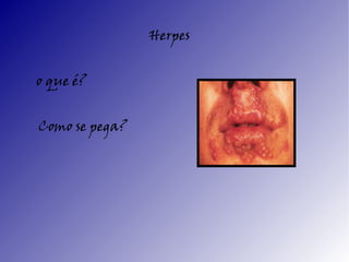 Herpes


o que é?


Como se pega?
 