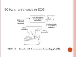 60 HZ INTERFERENCE IN ECG
 