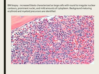 BM biopsy : increased blasts characterized as large cells with round to irregular nuclear
contours, prominent nuclei, and mild amounts of cytoplasm. Background maturing
erythroid and myeloid precursors are identified.
 