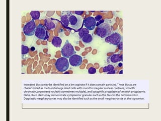 Increased blasts may be identified on a bm aspirate if it does contain particles.These blasts are
characterized as medium to large sized cells with round to irregular nuclear contours, smooth
chromatin, prominent nucleoli (sometimes multiple), and basophilic cytoplasm often with cytoplasmic
blebs. Rare blasts may demonstrate cytoplasmic granules such as the blast in the bottom center.
Dysplastic megakaryocytes may also be identified such as the small megakaryocyte at the top center.
 