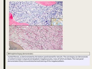 BM trephine biopsy demonstrates :
marked fibrosis, as demonstrated by the bottom panel stained for reticulin.The core biopsy can demonstrate
a marked increase in atypical and dysplastic megakaryocytes, many of which are blasts.The inset panel
demonstrates CD117 immunohistochemical staining of the megakaryoblasts.
 
