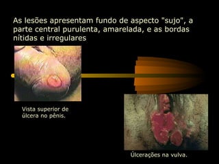 Vista superior de úlcera no pênis. As lesões apresentam fundo de aspecto "sujo", a parte central purulenta, amarelada, e as bordas nítidas e irregulares   Úlcerações na vulva.   