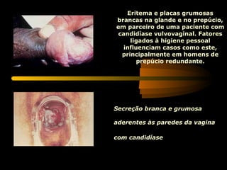Eritema e placas grumosas brancas na glande e no prepúcio, em parceiro de uma paciente com candidíase vulvovaginal. Fatores ligados à higiene pessoal influenciam casos como este, principalmente em homens de prepúcio redundante. Secreção branca e grumosa  aderentes às paredes da vagina com candidíase .   