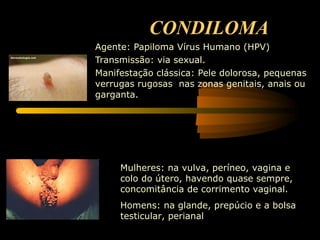 CONDILOMA Agente: Papiloma Vírus Humano (HPV)  Transmissão: via sexual.  Manifestação clássica: Pele dolorosa, pequenas verrugas rugosas  nas zonas genitais, anais ou garganta. Mulheres: na vulva, períneo, vagina e colo do útero, havendo quase sempre, concomitância de corrimento vaginal.  Homens: na glande, prepúcio e a bolsa testicular, perianal 