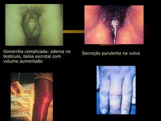 Secreção purulenta na vulva Gonorréia complicada: edema no testículo, bolsa escrotal com volume aumentado . 
