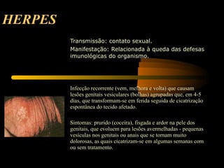 HERPES Transmissão: contato sexual. Manifestação: Relacionada à queda das defesas imunológicas do organismo.  Infecção recorrente (vem, melhora e volta) que causam lesões genitais vesiculares (bolhas) agrupadas que, em 4-5 dias, que transformam-se em ferida seguida de cicatrização espontânea do tecido afetado.  Sintomas: prurido (coceira), fisgada e ardor na pele dos genitais, que evoluem para lesões avermelhadas - pequenas vesículas nos genitais ou anais que se tornam muito dolorosas, as quais cicatrizam-se em algumas semanas com ou sem tratamento. 