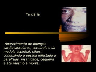   Aparecimento de doenças cardiovasculares, cerebrais e da medula espinhal, olhos, conduzindo a pessoa infectada a paralisias, insanidade, cegueira e até mesmo a morte.  Terciária 