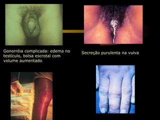 Secreção purulenta na vulva Gonorréia complicada: edema no testículo, bolsa escrotal com volume aumentado . 