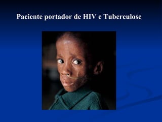 Paciente portador de HIV e Tuberculose 