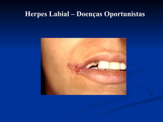 Herpes Labial – Doenças Oportunistas 